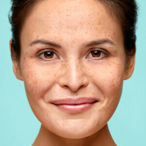 Biodermal Littekencreme 25 ml
